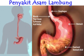 Pengobatan Herbal Asam  Lambung  Menjaga Kesehatan Dengan 