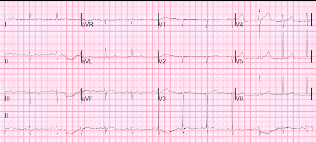 Does a Single Troponin below the 99th percentile URL Rule out Acute MI if the Chest pain is very prolonged?
