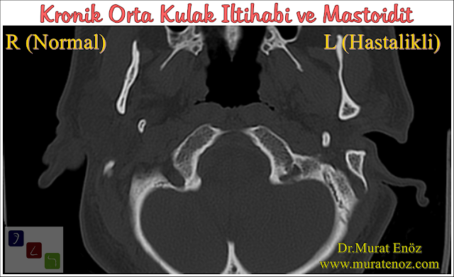 Mastoidit nedir? - Mastoidit neden olur? - Mastoidit nasıl anlaşılır? - Mastoidit belirtileri - Mastoidit nasıl tedavi edilir? - Mastoidit tedavisi ve önlenmesi