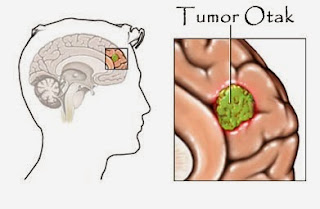 Gejala Awal Penyakit Tumor Otak