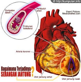 jantung, penyakit jantung, sakit jantung, cara mengobati sakit jantung,cara mengobati penyakit jantung, gambar jantung, serangan jantung