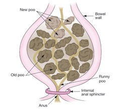 333ConstipatedRectumDiagram