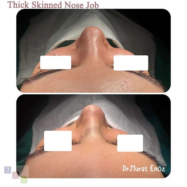 Thick Skinned Nose Job,  Istanbul plastic surgery,specialized surgeons,nasal enhancement,ethnic rhinoplasty experts.,Thick skinned nose,Istanbul ethnic rhinoplasty,cultural nose surgery Turkey,