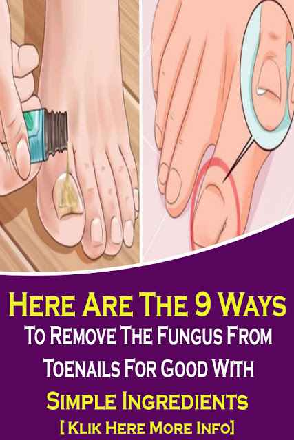 Here Are The 9 Ways To Remove The Fungus From Toenails For Good With Simple Ingredients