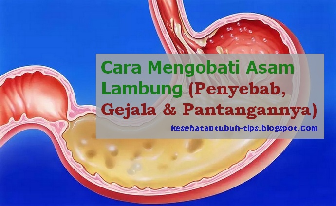 Tips Mengobati Gangguan Asam Lambung 