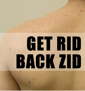 How to Get Rid of Back Acne Fast at Home