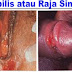 Ciri - Ciri Terkena Penyakit Sipilis Raja Singa