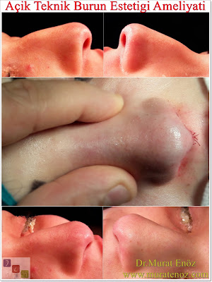 Açık rinoplasti ameliyatı sonrası - Açık rinoplasti mi kapalı rinoplasti mi? - Açık burun ameliyatı iyileşme süreci - Açık burun ameliyatımı kapalı burun ameliyatı mı? - Açık ve kapalı burun ameliyatı arasındaki fark - Açık burun ameliyatı videosu izle - Açık burun ameliyatında iz kalır mı? - Open technique rhinoplasty - Closed technique rhinoplasty - Rhinoplasty in Istanbul - Rhinoplasty in Turkey - Rhinoplasty photos in Istanbul