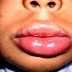 Angioedema