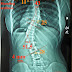 脊椎側彎矯正案例2 - 治療一個月成果：9度+後續追蹤一(5個月16.5度)
