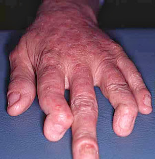 Artritis Psoriásica