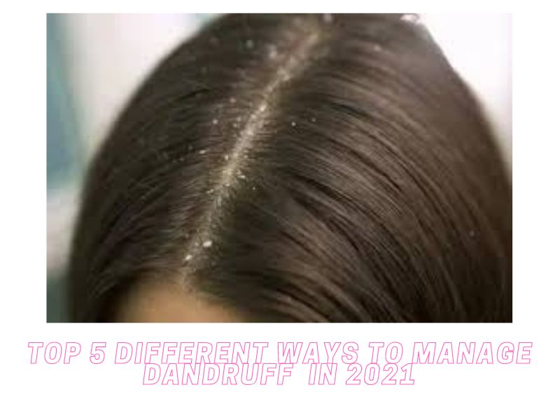 Top 5 different ways to manage dandruff  in 2021