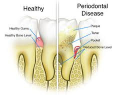 periodontal disease treatment