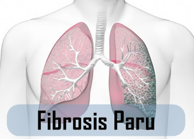 Cara Menyembuhkan Fibrosis Paru Secara Alami