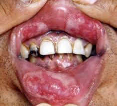 Sipilis di lidah Sipilis di lidah