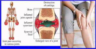 Obat Herbal Rematik