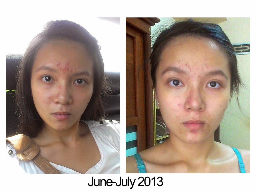 My Acne Story Mild Acne Now And Day 10 On Accutane With Dr Ranjit