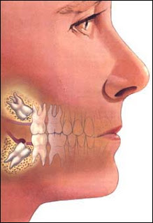 teeth extraction in Poland