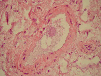 Fat Embolism