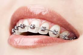 Orthodontics  Melbourne