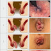 Obat Wasir Selain Ardium thumbnail