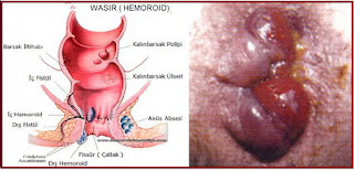 obat wasir untuk ibu menyusui