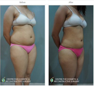 Liposuction in Mumbai