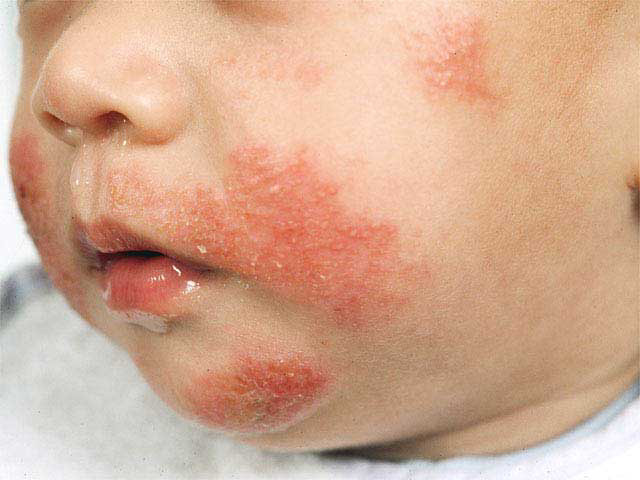 Pediatric Health Atopic Dermatitis Eczema In Children