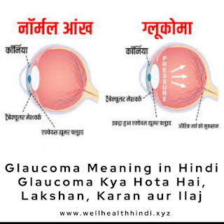 Glaucoma Meaning in Hindi: Glaucoma Kya Hota Hai, Lakshan, Karan aur Ilaj