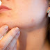 Tips to Reduce the Severity of Acne