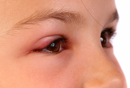 Lots of tearing:viral and allergic Pinkeye are known for causing more tear 