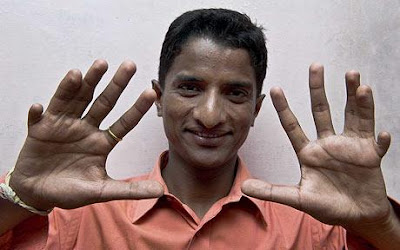 Man has 12 fingers and 14 toes