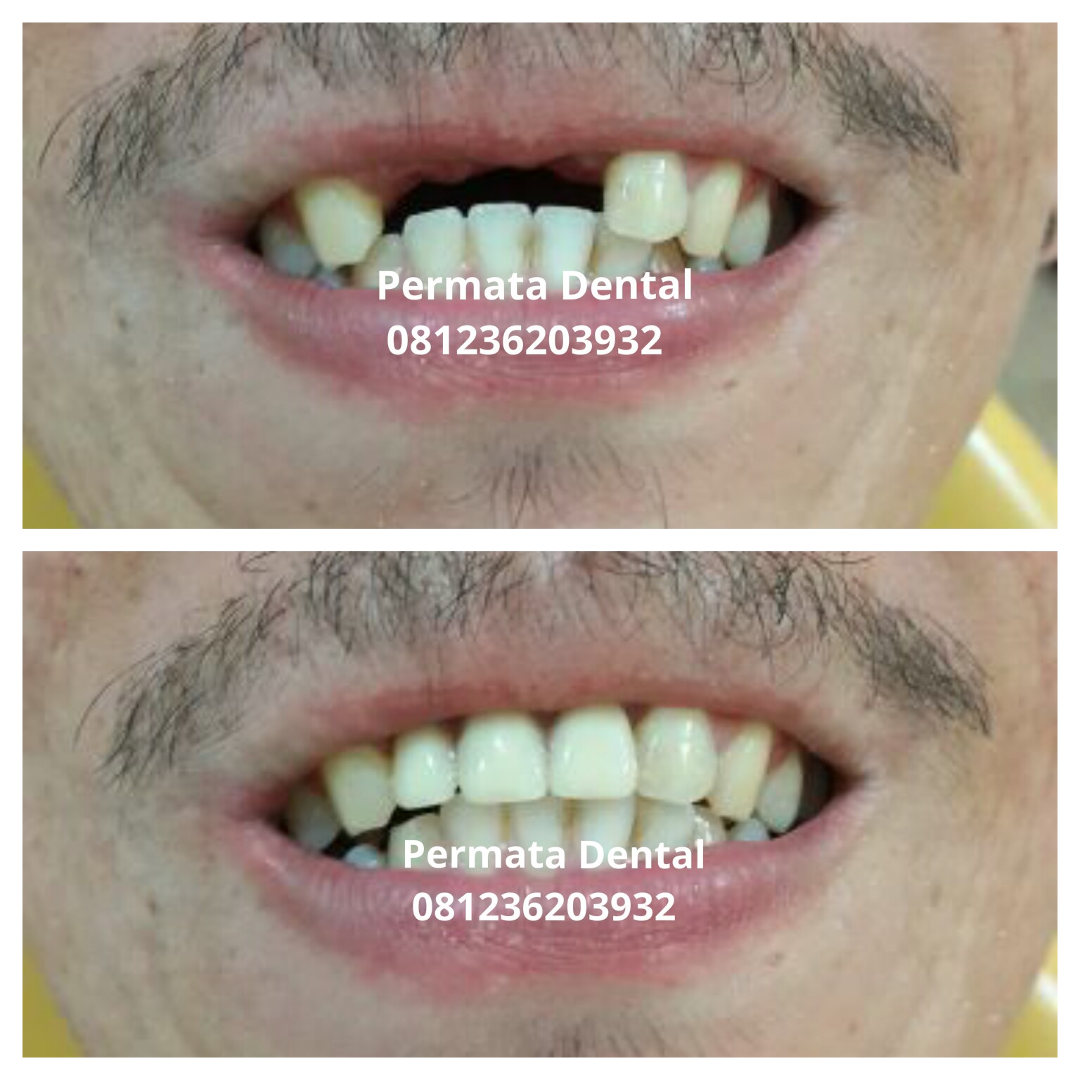 Ahli Gigi  Bali Permata Dental Pasang  Gigi  Palsu Lepas 