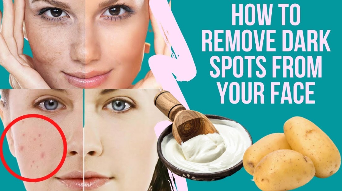 How to Remove Dark Spots on Face Overnight?