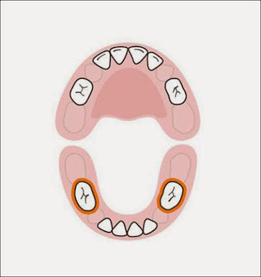 Cần bảo vệ răng số 6 hàm dưới khỏi bị sâu 