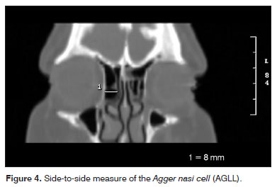 Agger Nasi Cell Types5