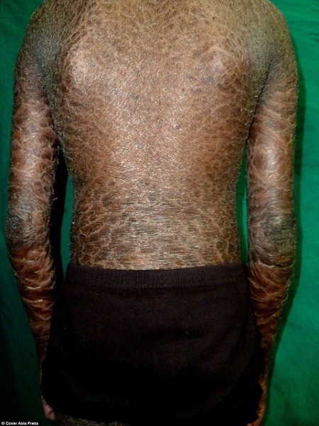 Oh No! Rare Skin Disease Leaves Brother and Sister with Scales all Over Their Bodies (Photos)