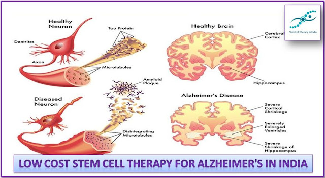 فوائد من حيث التكلفة ومنخفضة العلاج بالخلايا الجذعية لمرض الزهايمر في الهند