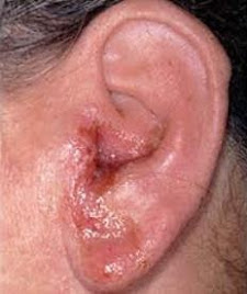 Otitis Externa