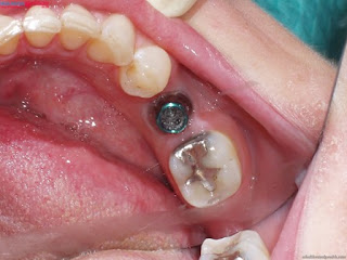 Cấy ghép răng implant ở đâu tốt và uy tín ?