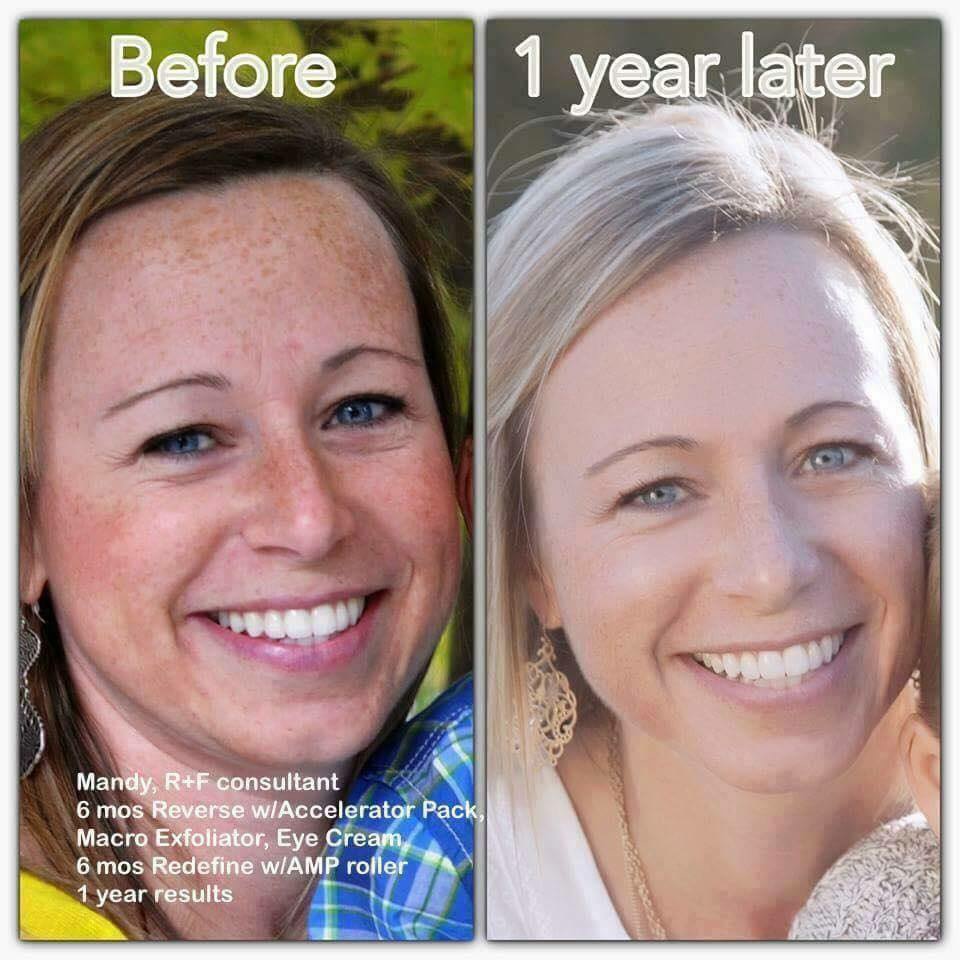  helped change my skin, sun damage &amp; got rid of my pregnancy melasma