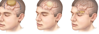 How Neurosurgeons Approach Pediatric Brain Tumors