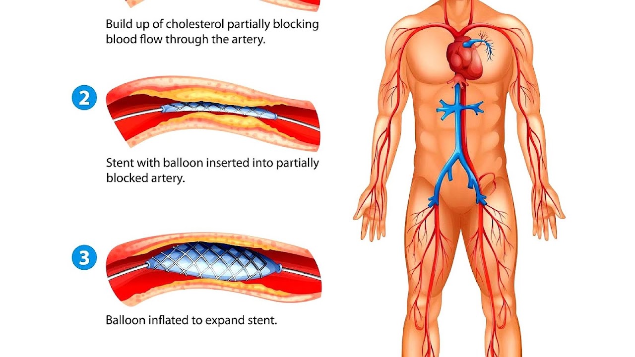Stent Heart Blockage