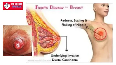 What Is Paget's Disease Of The Breast?