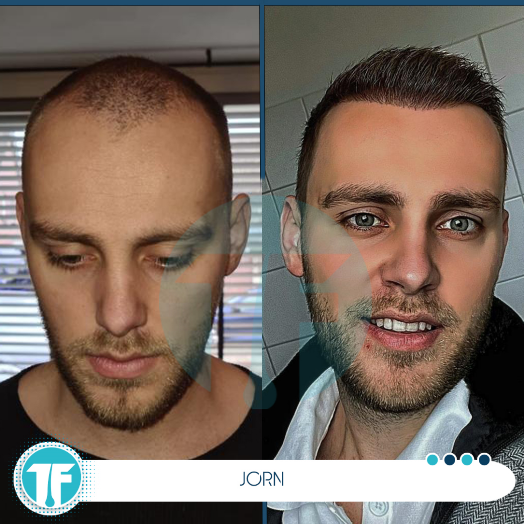 before and after images of hair transplant results