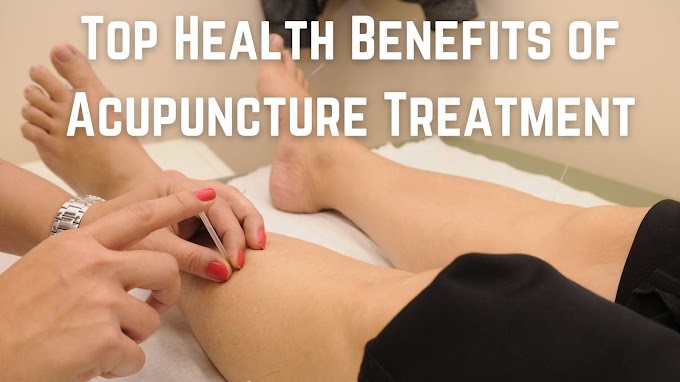 Top Health Benefits of Acupuncture Treatment