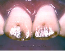<Img src ="fluorosis-dental-Cuba.jpg" width = "220" height "172" border = "0" alt = "Fluorosis dental | Foto clínica de la alteración observable en dos dientes de niños cubanos.">