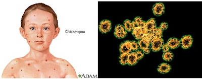 Virus variola penyebab cacar
