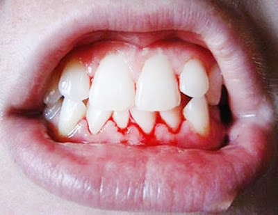 Tìm hiểu về bệnh viêm nha chu