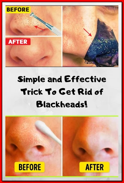 Remove Blackheads & One Simple & Effective Trick!!!